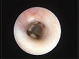 耳道内の黄色の分泌物