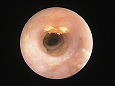 耳道内の黄色の分泌物