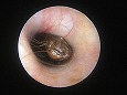 耳垢栓(左耳）