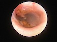 弛緩部と鼓膜外側面凹部に耳垢と分泌物
