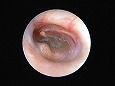 同じ場所(弛緩部と鼓膜外側面凹部)に耳垢と分泌物がたまる