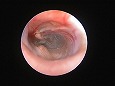 鼓膜についた毛と鼓膜外側面凹部の耳垢と分泌物