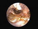 耳道をふさぐdebris